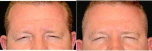 33 Year Old Man Treated With Botox And Restylane With Doctor Michael Law, MD, Raleigh-Durham Plastic Surgeon