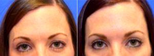 33 Year Old Woman Treated With Botox Before & After By Dr Jason Brett Lichten, MD, Columbus Plastic Surgeon