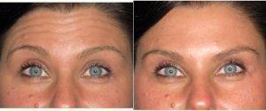 33 Year Old Woman Treated With Botox With Dr Don W. Griffin, MD, Nashville Plastic Surgeon