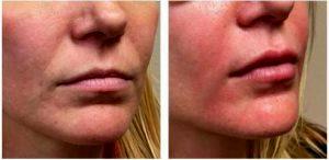 34 Year Old Female 0.7 Syringe Of Juvederm Ultra XC To Add Volume To The Pink Lip By Scottsdale Plastic Surgeon, Dr. John J. Corey, MD (2)