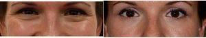 34 Year Old Woman Treated With Botox For Crow's Feet By Dr Karol A. Gutowski, MD, FACS, Chicago Plastic Surgeon