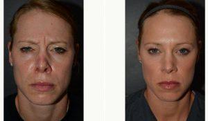 34 Year Old Woman Treated With Botox To Glabella By Dr. Edwin Cortez, MD, FACS, Overland Park Facial Plastic Surgeon