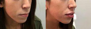 34 Year Old Woman Treated With Juvederm Before & After By Dr. Justin Harper, MD, Columbus Physician
