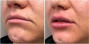 34 Year Old Woman Treated With Juvederm Before & After With Doctor John J. Corey, MD, Phoenix Plastic Surgeon