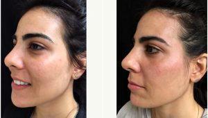 34 Year Old Woman Treated With Voluma With Dr Michele S. Green, MD, New York Dermatologist