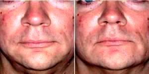 35 Year Old Male Treated For Jawline Contouring By Doctor Jason Emer, MD, Los Angeles Dermatologic Surgeon