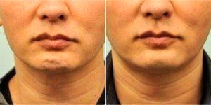 35 Year Old Man Treated With Botox To The Chin Before And After By Dr. Joseph A. Eviatar, MD, FACS, New York Oculoplastic Surgeon