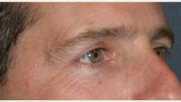 35 Year Old Man Treated With Botox With Dr. William Groff, DO, San Diego Dermatologist