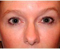 35 Year Old Woman Treated With Botox By Dr Timothy M. Greco, MD, FACS, Philadelphia Facial Plastic Surgeon