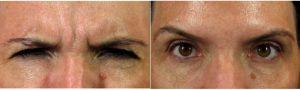 35 Year Old Woman Treated With Botox For Furrowed Brow