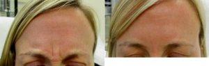 35 Year Old Woman Treated With Botox With Doctor Benjamin Barankin, MD, FRCPC, Toronto Dermatologic Surgeon