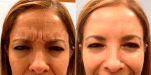 35 Year Old Woman Treated With Botox With Dr. Jose Rodríguez-Feliz, MD, Miami Plastic Surgeon