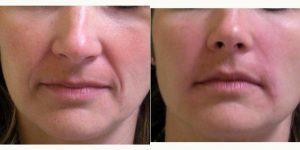 35 Year Old Woman Treated With Juvederm Before & After By Dr. Jeff Angobaldo, MD, Dallas Plastic Surgeon