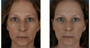 35 Year Old Woman Treated With Restylane Before & After By Doctor Jonathan Kulbersh, MD, Charlotte Facial Plastic Surgeon