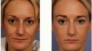35 Year Old Woman Treated With Restylane Before & After By Dr Grant Stevens, MD, Los Angeles Plastic Surgeon