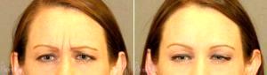 36 Y O Female Desired A Refreshed Look. By Dr. Robert G. Bonillas, MD, Scottsdale Plastic Surgeon