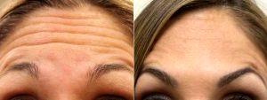 36 Year Old Female Treated For Forehead Wrinkles Before After By Doctor Michael Marion, MD, Sandy Plastic Surgeon
