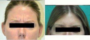 36 Year Old Woman Treated With Botox Before And After By Dr. B. Aviva Preminger, MD, New York Plastic Surgeon