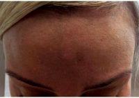36 Year Old Woman Treated With Botox By Dr. Ramandeep Sidhu, MD, Issaquah Vascular Surgeon