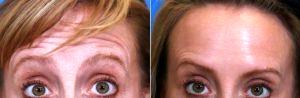 36 Year Old Woman Treated With Botox For Forehead Wrinkles With Dr. Andrew Campbell, MD, Milwaukee Facial Plastic Surgeon