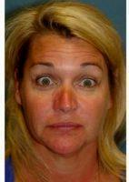 36 Year Old Woman Treated With Botox With Dr. William Marshall Guy, MD, The Woodlands Facial Plastic Surgeon