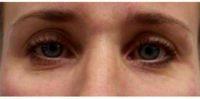 36 Year Old Woman Treated With Restylane In Tear Troughs By Dr. Steven F. Weiner, MD, Panama City Facial Plastic Surgeon