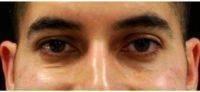 37 Year Old Male Treated With Botox For Crow's Feet With Dr. Shaun Patel, MD, Miami Physician