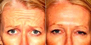 37 Year Old Woman Treated With Botox Before And After With Dr. Sabrina Fabi, MD, San Diego Dermatologic Surgeon