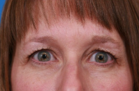 37 Year Old Woman Treated With Botox Between Eyebrows With Dr Andrew Campbell, MD, Milwaukee Facial Plastic Surgeon