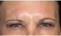 37 Year Old Woman Treated With Botox With Dr Don W. Griffin, MD, Nashville Plastic Surgeon
