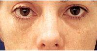 37 Year Old Woman Treated With Restylane With Dr. Robert W. Sheffield, MD, Santa Barbara Plastic Surgeon