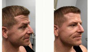 38 Year Old Man Treated With Botox Before & After With Dr. Justin Harper, MD, Columbus Physician