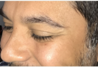 38 Year Old Man Treated With Botox With Doctor Luis M. Rios Jr., MD, Edinburg Plastic Surgeon