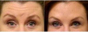 38 Year Old Woman Treated With Botox And Restylane With Doctor G. Peter Fakhre, MD, Tampa Plastic Surgeon