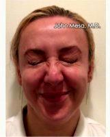 38 Year Old Woman Treated With Botox For Wrinkles Between The Eyebrows- Glabella Region ('11's') By Doctor John Mesa, MD, New York Plastic Surgeon