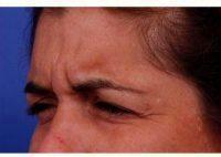 38 Year Old Woman Treated With Botox Treatment Areas Include Glabella, Crows Feet, Jelly Roll By Dr Thomas J. Walker, MD, Atlanta Facial Plastic Surgeon