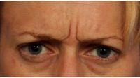 38 Year Old Woman With Frown Lines Treated With Botox By Dr Grant Stevens, MD, Los Angeles Plastic Surgeon