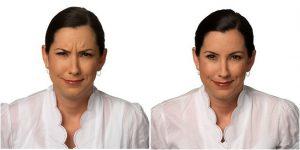 39 Year Old Female Botox By Lorrie Klein, MD, Doctor In Laguna Niguel, California