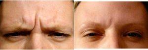 39 Year Old Woman Treated With Botox For a Furrowed Brow
