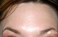 39 Year Old Woman Treated With Botox With Dr Suzanne Kilmer, MD, Sacramento Dermatologic Surgeon