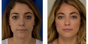39 Year Old Woman Treated With Juvederm Before & After By Dr. Sean R. Weiss, MD, FACS, New Orleans Facial Plastic Surgeon