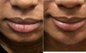 39 Year Old Woman Treated With Restylane Before & After With Doctor Justin Harper, MD, Columbus Physician