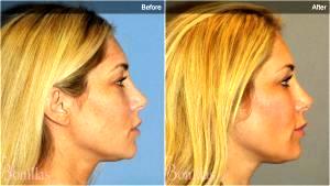 39 Yo Female Augmentation And Shaping Of Her Cheek Bones (malar Region) Woth Voluma By Dr. Robert G. Bonillas, MD, Scottsdale AZ Plastic Surgeon (3)