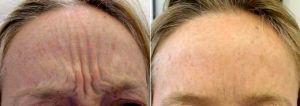 40 Year Old Female Treated For Frown Lines With Botox And Restylane By Dr. Benjamin Barankin, MD, FRCPC, Toronto Dermatologic Surgeon