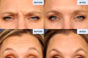 40 Year Old Patient Eceived 30 Units Of Botox To The Forehead And Eyebrows By Dr. David Broadway, Denver Plastic Surgeon