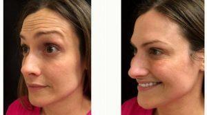 40 Year Old Woman Treated With Botox Before And After With Dr Michele S. Green, MD, New York Dermatologist