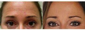 40 Year Old Woman Treated With Botox For Forehead Lines With Dr. Dominic Brandy, MD, Pittsburgh Physician