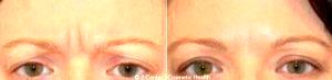 40 Year Old Woman Treated With Botox To The Glabellar Area Before And After By Dr Michael A. Zadeh, MD, FACS, Sherman Oaks General Surgeon
