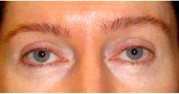 40 Year Old Woman Treated With Botox With Doctor Daniel Levy, MD, Bellevue Dermatologic Surgeon
