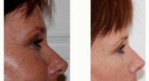 40 Year Old Woman Treated With Botox With Dr Anand G. Shah, MD, San Antonio Facial Plastic Surgeon